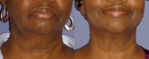 forma results CARE