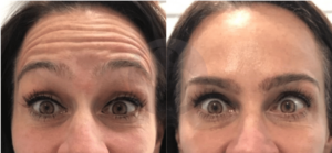 Botox before and after Cary North Carollina