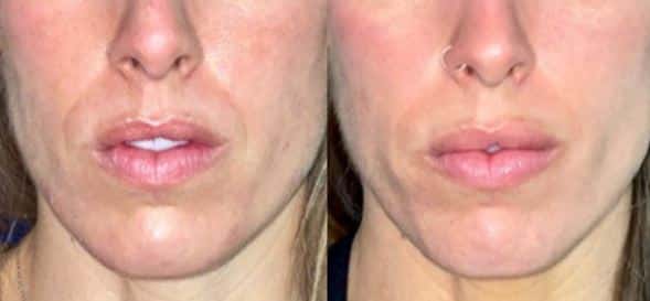 Before and After Juvederm Lip Filler