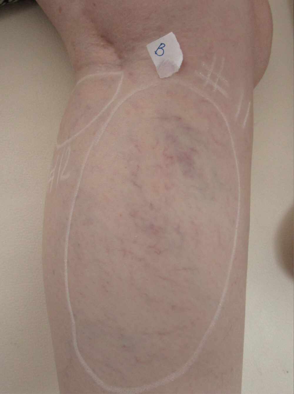 Patient #94568 Before Image