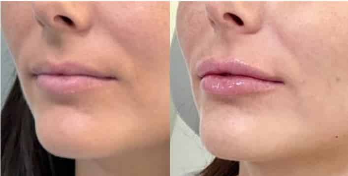 Juvederm Before and after blog