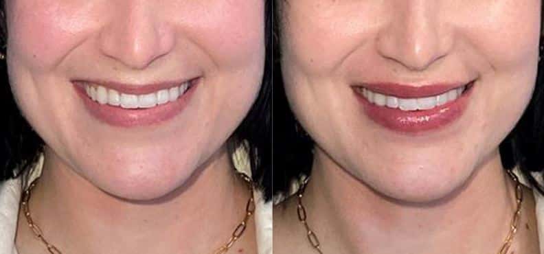 Juvederm,before,and,after, lips,