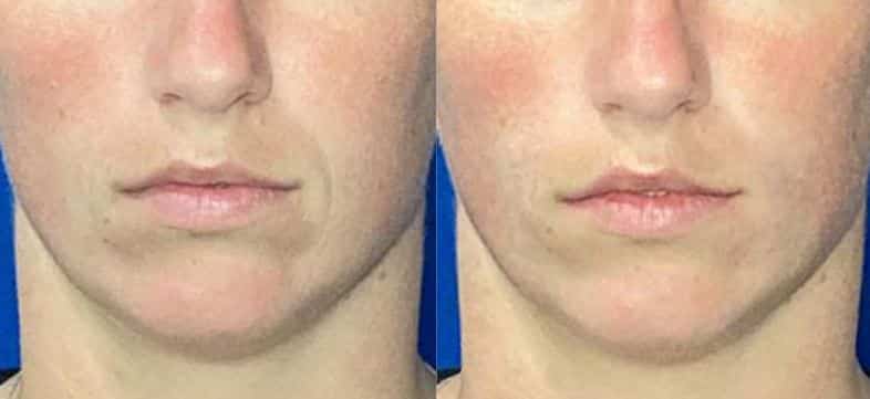 Juvederm,Male,before,and,after case