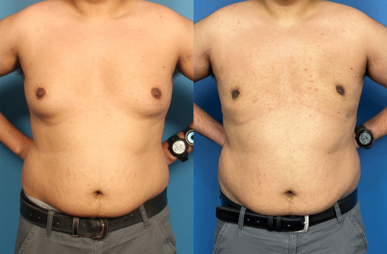 before and after male breast reduction gynecomastia