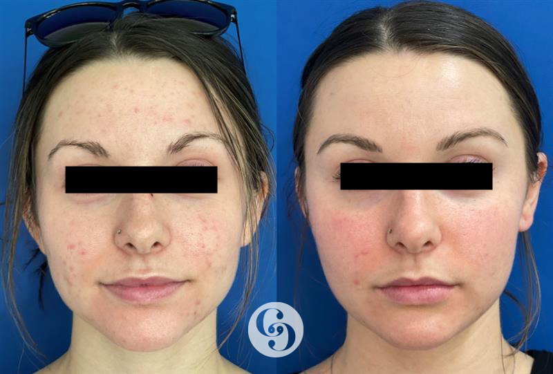 Morpheus8 for Acne at CARE Plastic Surgery in Cary North Carolina