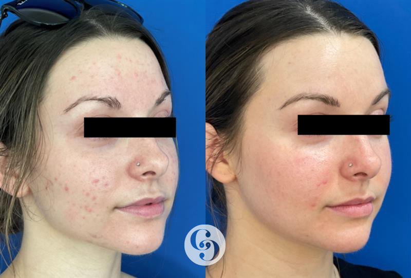 Morpheus8 for Acne at CARE Plastic Surgery in Cary North Carolina