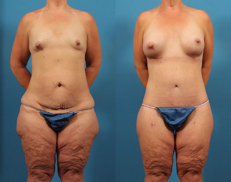 Non-Invasive Body Contouring in Cary, NC